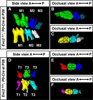 Elevated WNT signaling and compromised Hedgehog signaling due to Evc2 loss of function contribute to the abnormal molar patterning